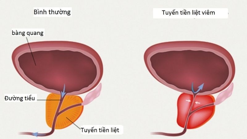 Bác sĩ có thể kiểm tra tuyến tiền liệt thông qua kiểm tra vật lý