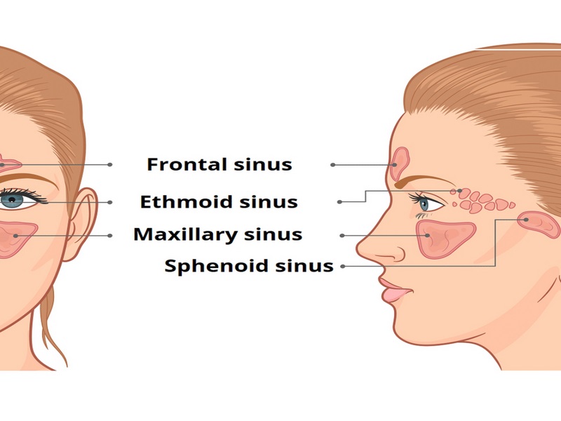 Viêm xoang xảy ra khi vi khuẩn hoặc virus xâm nhập vào các xoang và gây viêm