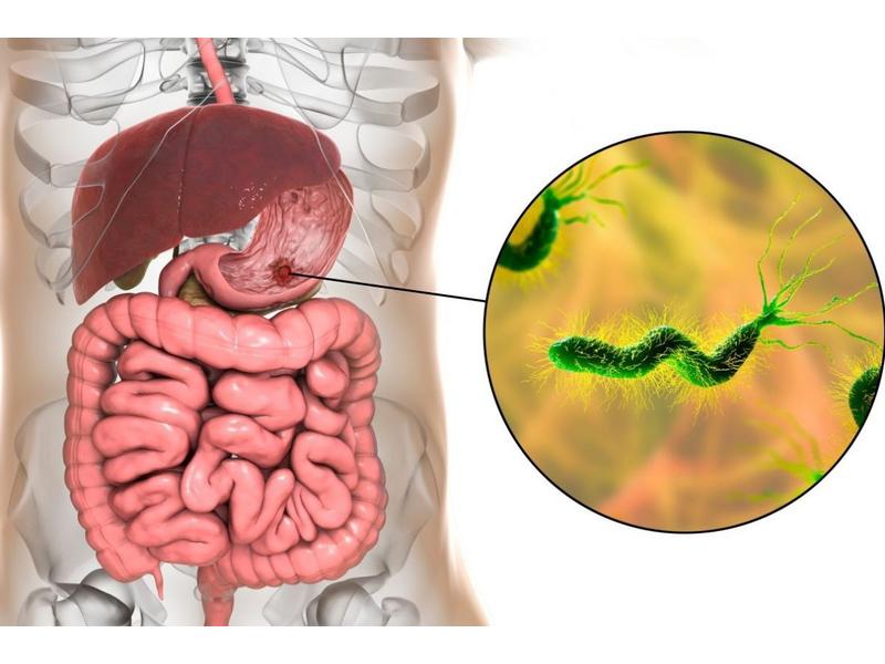 Helicobacter pylori là tác nhân gây ra khoảng 70% trường hợp bệnh lý dạ dày