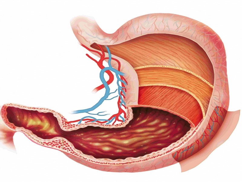 Viêm dạ dày ruột cấp tính là gì?