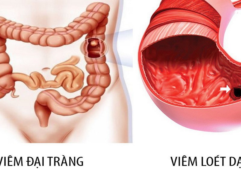 Xét nghiệm máu có thể giúp phát hiện tình trạng viêm nhiễm