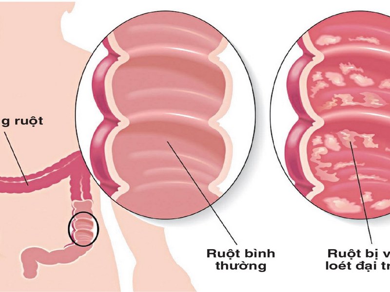 Bác sĩ có thể kê đơn thuốc kháng viêm