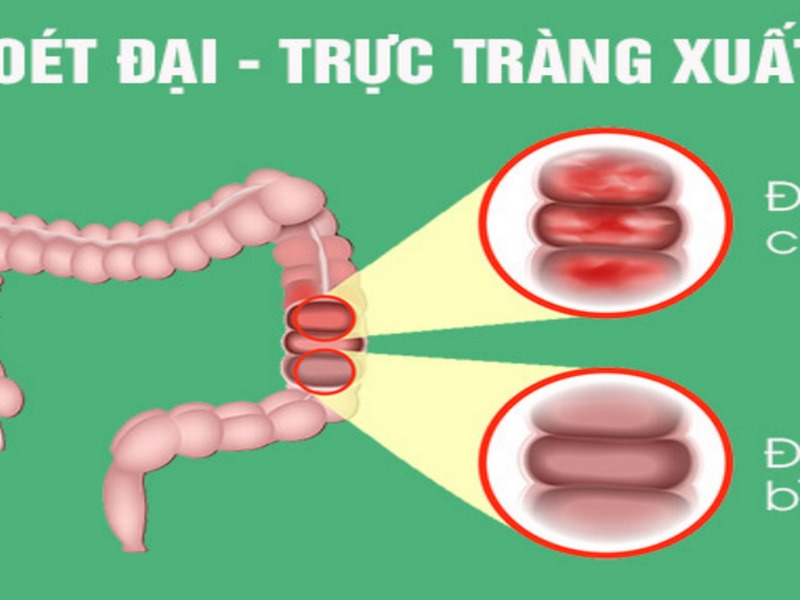 Viêm loét đại trực tràng chảy máu là gì?