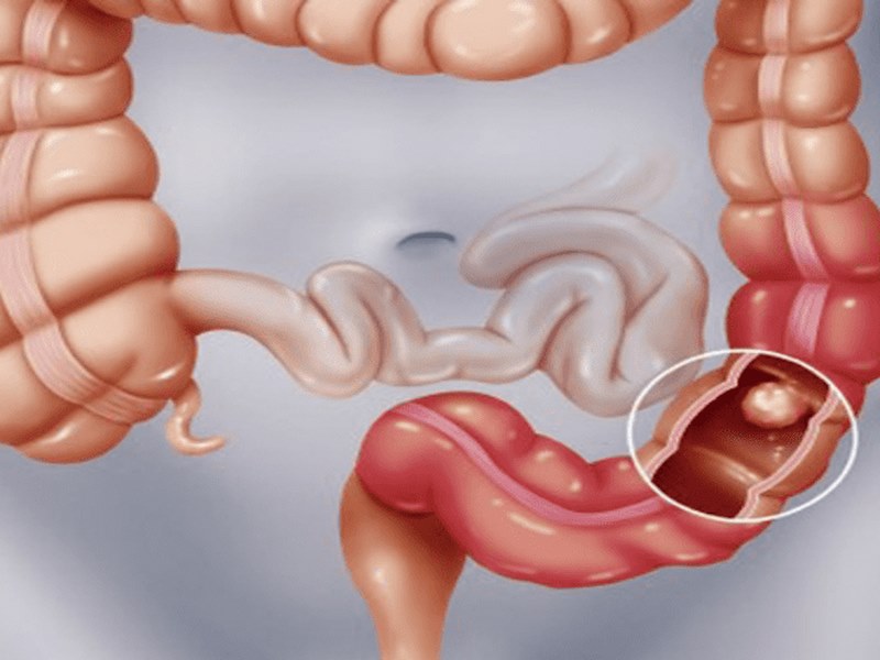 Ăn quá nhiều thực phẩm cay nồng