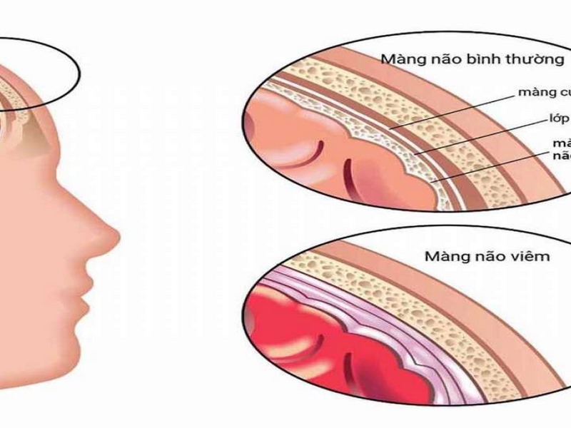 Viêm màng não mủ là gì?