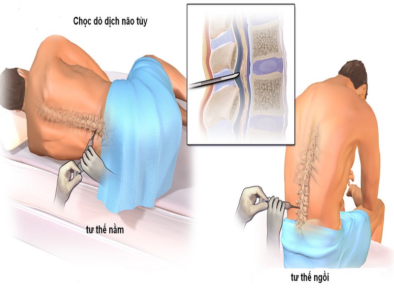 Chọc dò tủy sống để chẩn đoán viêm màng não mủ