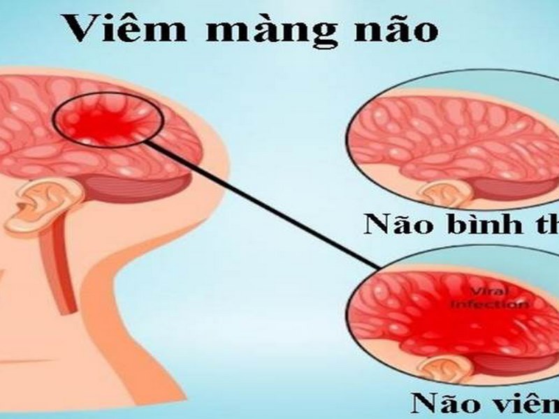 Viêm màng não vô khuẩn là gì?