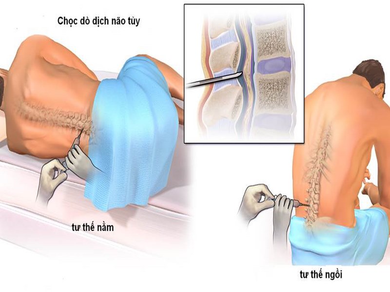 Chọc dịch não tủy là xét nghiệm thường được chỉ định 