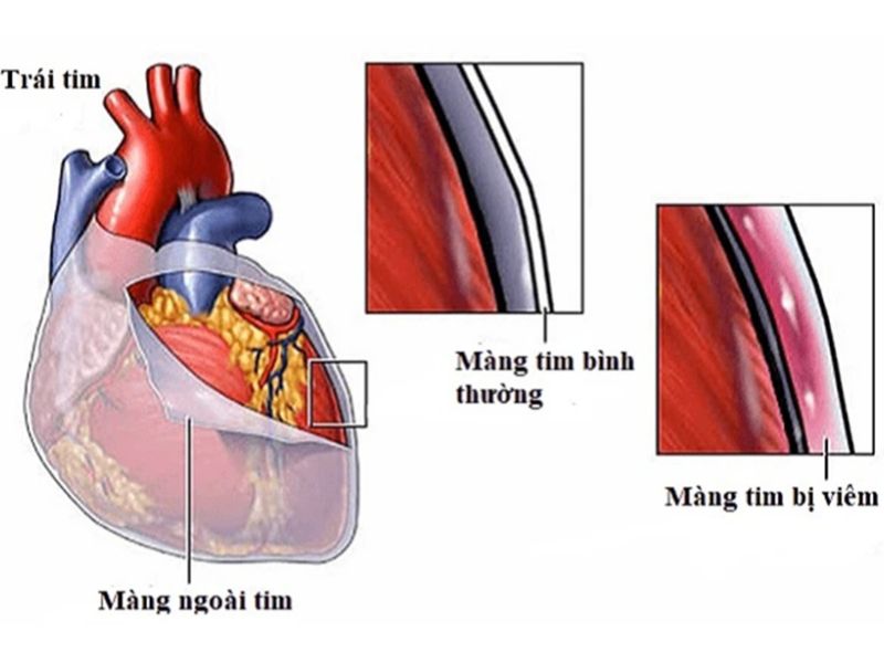 Bệnh viêm màng ngoài tim co thắt gây ra những triệu chứng của suy tim phải và trái