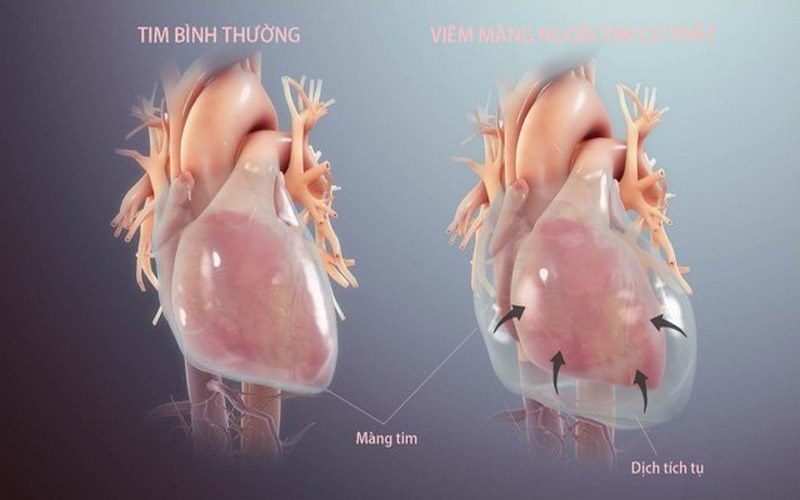 Tình trạng viêm màng ngoài tim