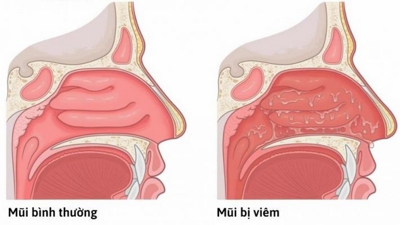 Xét nghiệm máu không phổ biến khi chuẩn đoán viêm mũi dị ứng