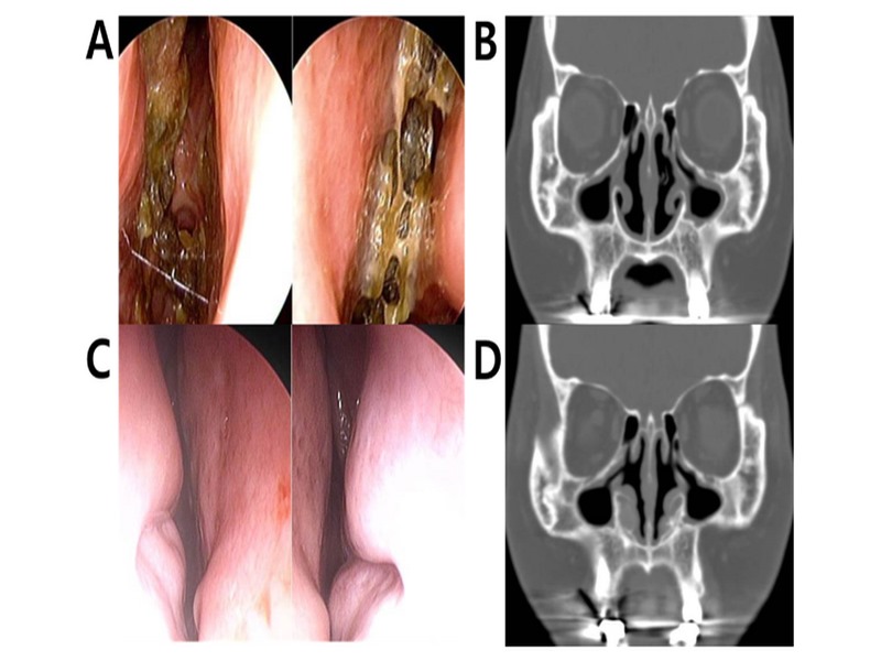 Hình ảnh nội soi và chụp cắt lớp vi tính trên người bệnh viêm mũi teo
