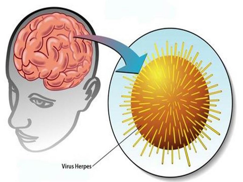 Nguyên nhân là do nhiễm vi-rút Herpes simplex