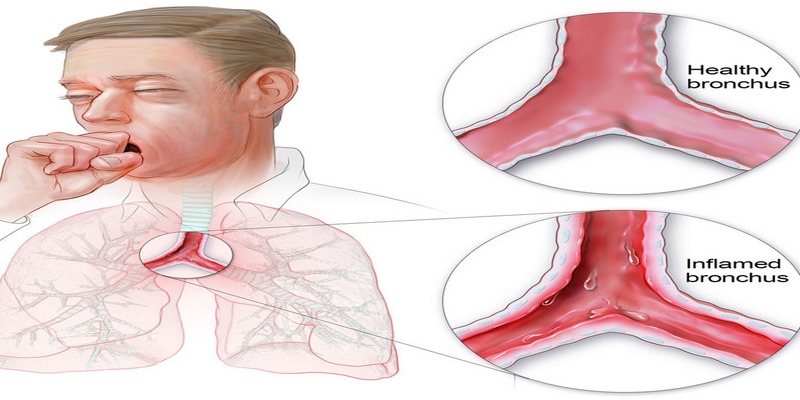 Có thể do nhiễm trùng vi khuẩn, virus hoặc nấm