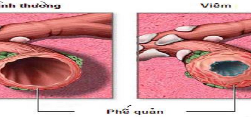 Viêm phế quản cấp tính là gì?