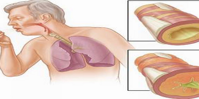 Người hút thuốc lá hoặc nghiện thuốc lá có nguy cơ cao hơn