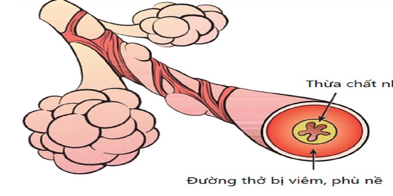 Viêm phế quản mạn tính là gì?