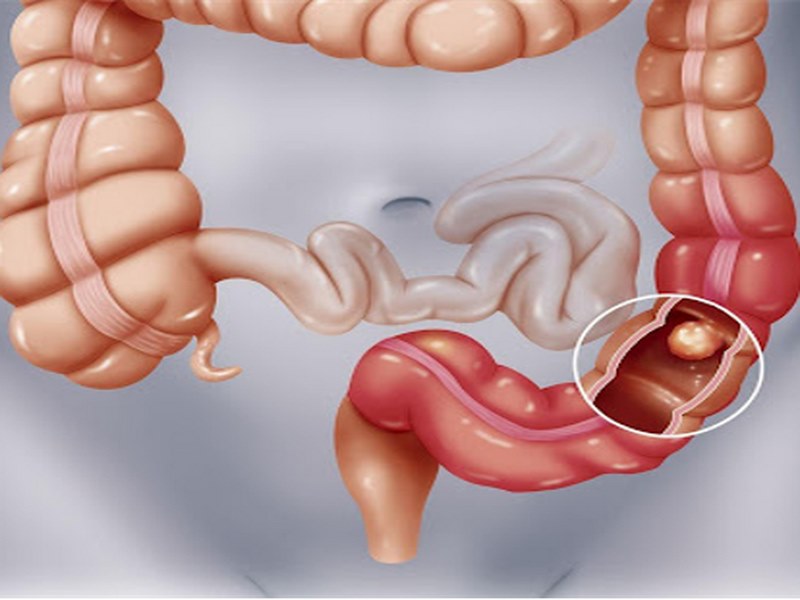 Người đã có tiền sử viêm phúc mạc trước đây