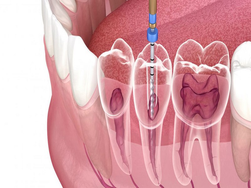 Sai sót trong điều trị tuỷ cũng là một nguyên nhân dẫn đến bệnh viêm quanh răng