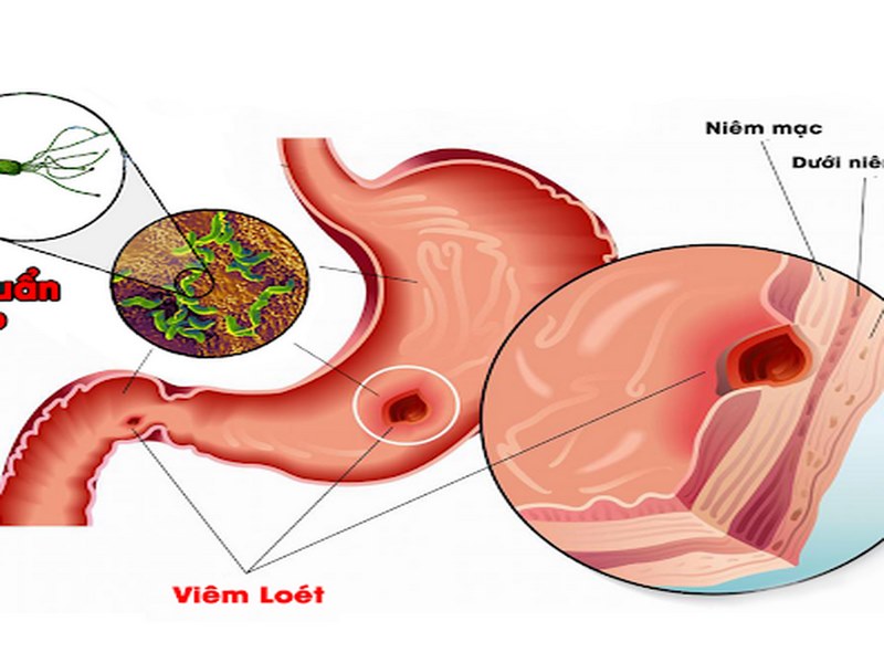 Giảm cân đột ngột không rõ nguyên nhân