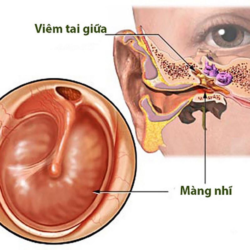 Trẻ em là độ tuổi dễ bị viêm tai giữa