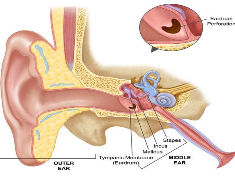 Viêm tai giữa thủng màng nhĩ là gì?