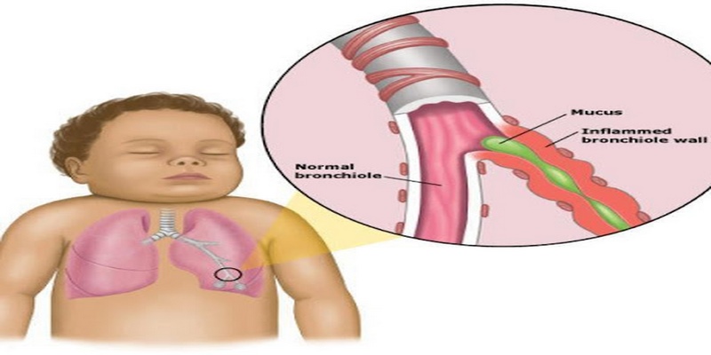 Hệ miễn dịch yếu có thể khiến cơ thể dễ bị nhiễm vi khuẩn gây viêm tiểu phế quản