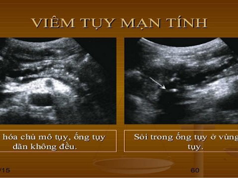 Viêm tụy mạn là gì?