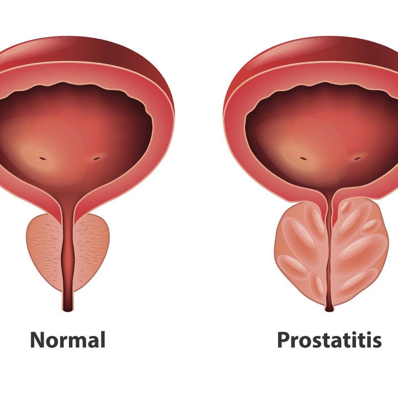 Tìm hiểu về viêm tuyến tiền liệt mạn tính