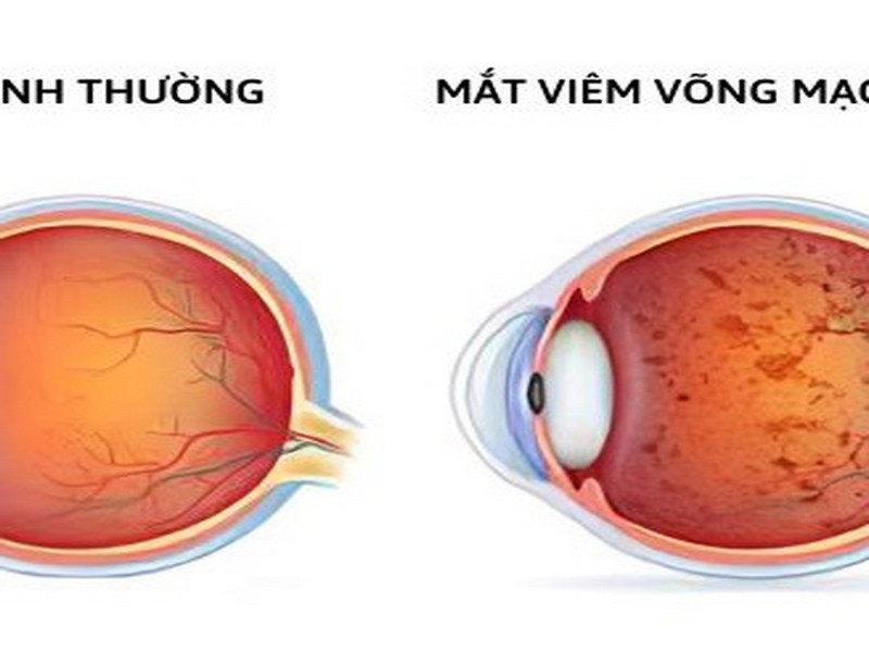 Viêm võng mạc là gì?