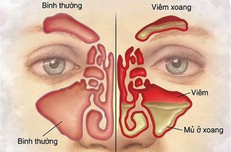 Dựa vào kết quả chuẩn đoán, bác sĩ sẽ đưa ra phác đồ điều trị phù hợp