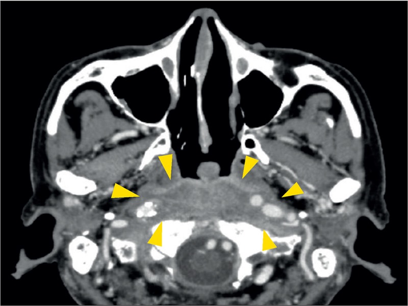 CT scan tăng cường độ tương phản sử dụng trong chẩn đoán viêm xương sọ