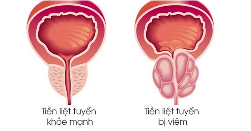 Những người trên 50 tuổi hoặc có tiền sử về viêm tuyến tiền liệt