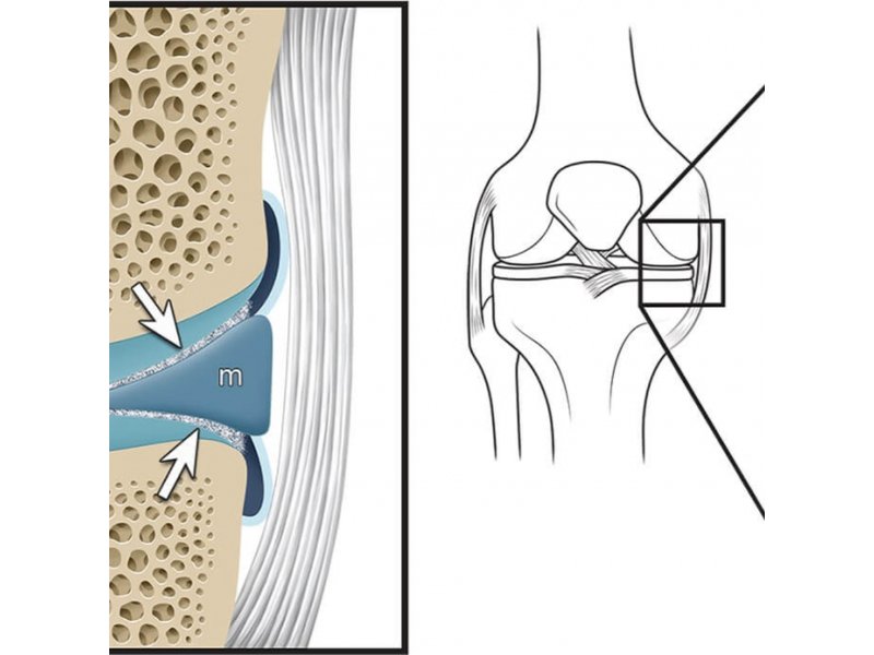 X-quang được sử dụng để xem sụn khớp