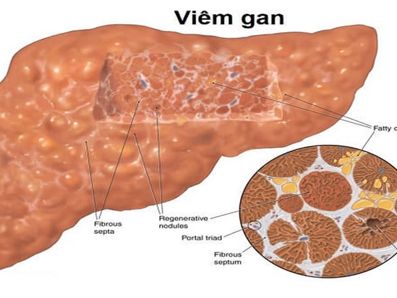 Người có bệnh tiêu hóa nặng nhất là viêm gan mạn