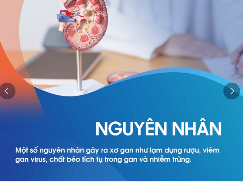 Xơ gan là một tình trạng trong đó các tế bào gan bị tổn thương do viêm