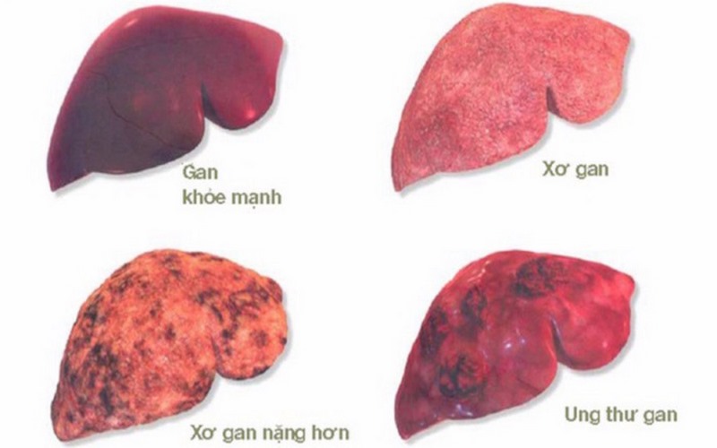 Xơ gan mất bù rất nguy hiểm, có thể ảnh hưởng đến tính mạng bệnh nhân