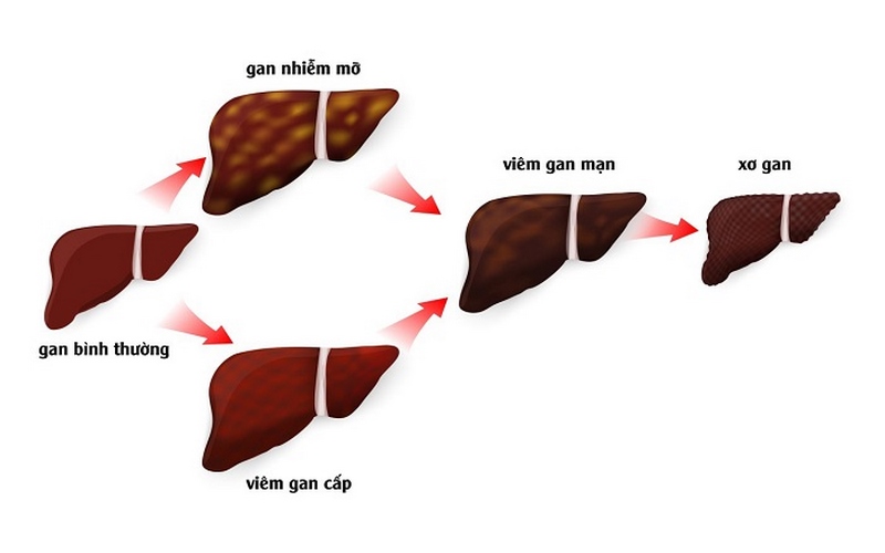 Gan nhiễm mỡ, viêm gan là những nguyên nhân dẫn đến xơ gan mất bù