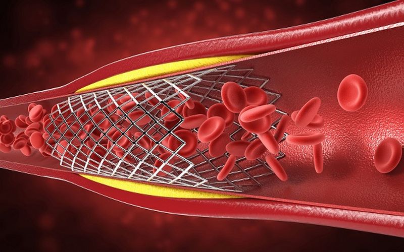 Đặt stent điều trị xơ vữa động mạch