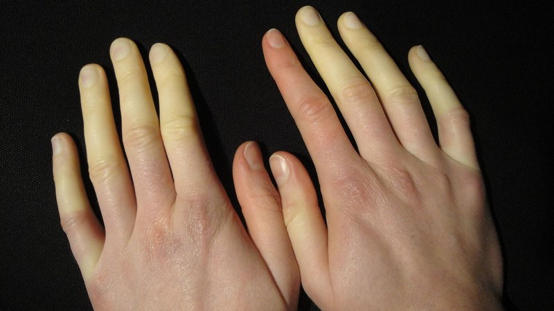 Hiện tượng Raynaud