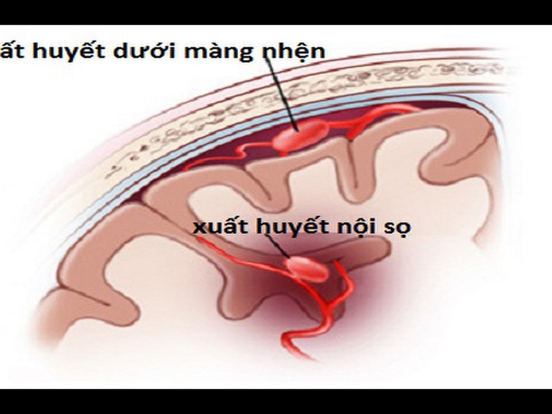 Xuất huyết dưới nhện là gì?