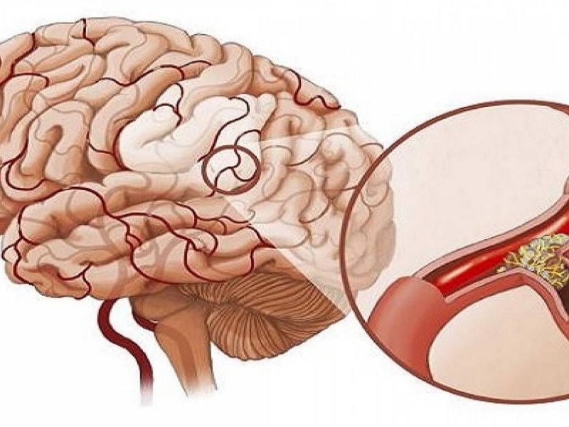 Bệnh xuất huyết não là gì?