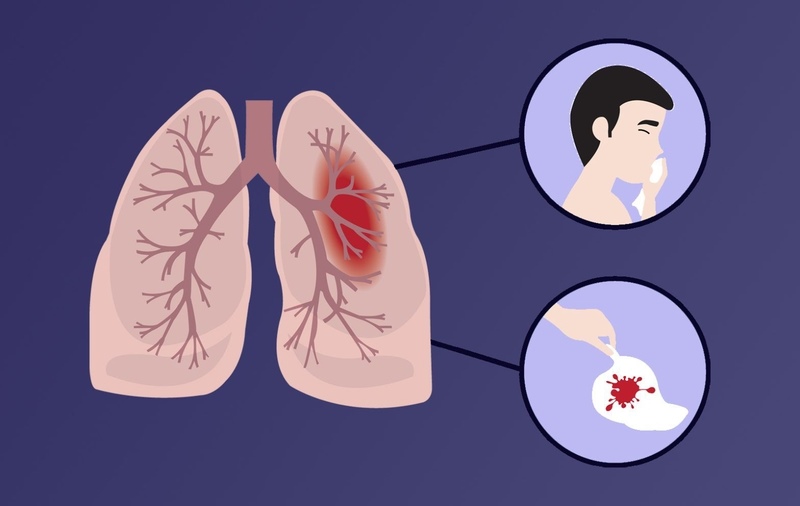 Ho máu và khó thở là triệu chứng gợi ý có tình trạng xuất huyết trong phế nang