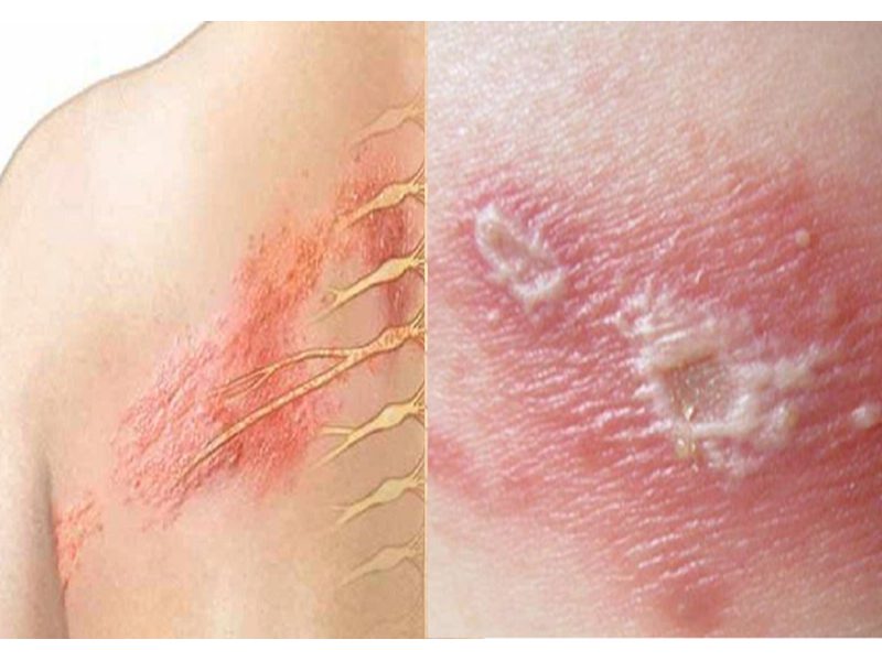 Zona thần kinh là bệnh do virus varicella-zoster gây nên