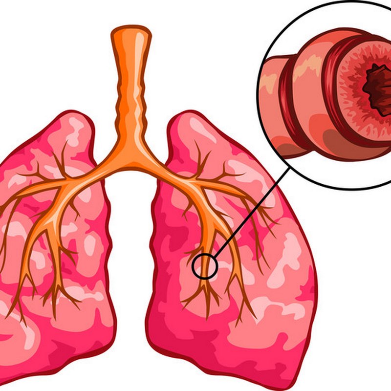 Triệu chứng của viêm phế quản co thắt