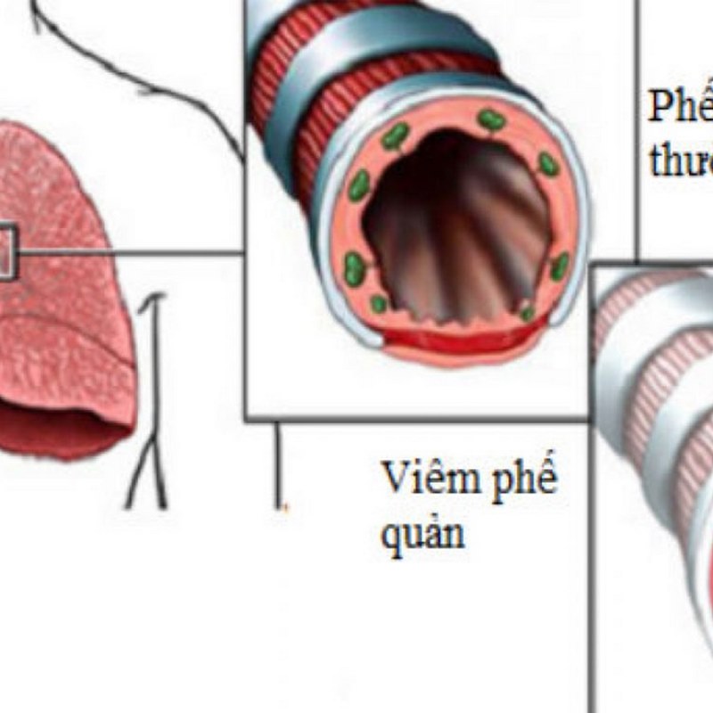 Viêm phế quản mạn tính