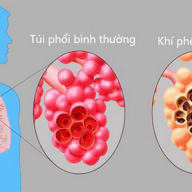 Triệu chứng của khí phế thũng