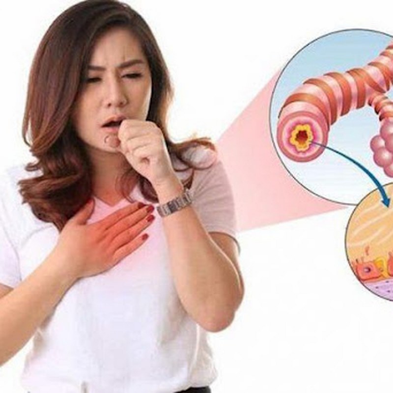 Triệu chứng của viêm phế quản cấp tính