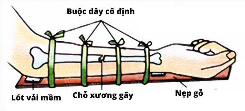 Quy trình sử dụng các loại nẹp gỗ y tế