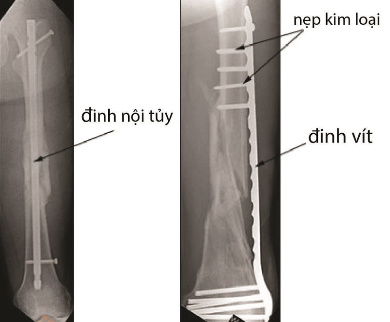 Phẫu thuật kết hợp xương bằng cố định ngoài